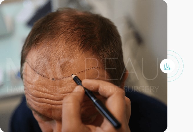 زراعة الشعر